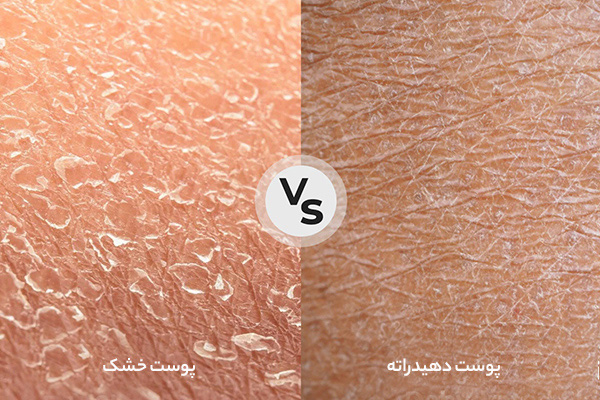 تفاوت پوست خشک و پوست دهیدراته 